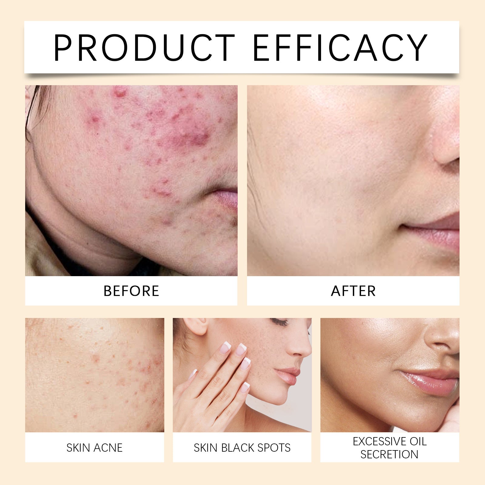 Lighten Acne Mark And Moisturize Face Cream