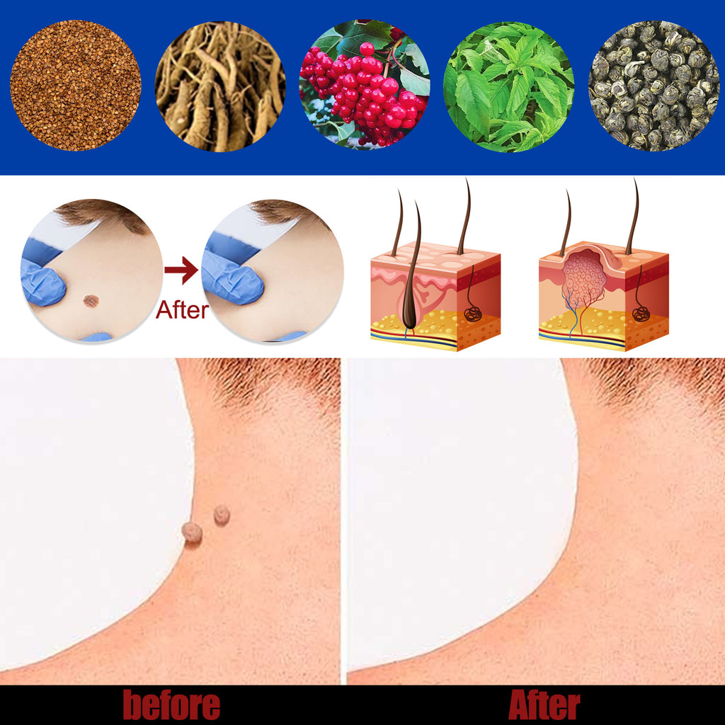 Hand Foot Face Underarm Wart Removing Cream